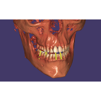 Exocad DentalCAD [Flex] [Standalone]