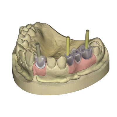 Exocad DentalCAD [Flex]