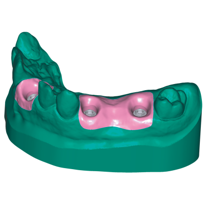 Exocad DentalCAD [Flex]